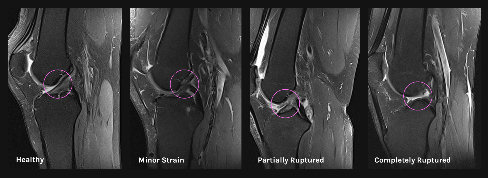 Visualization of different ACL conditions