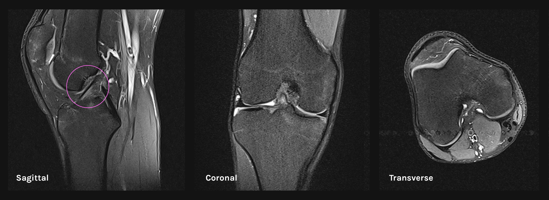 ACL preview in three basic anatomical planes
